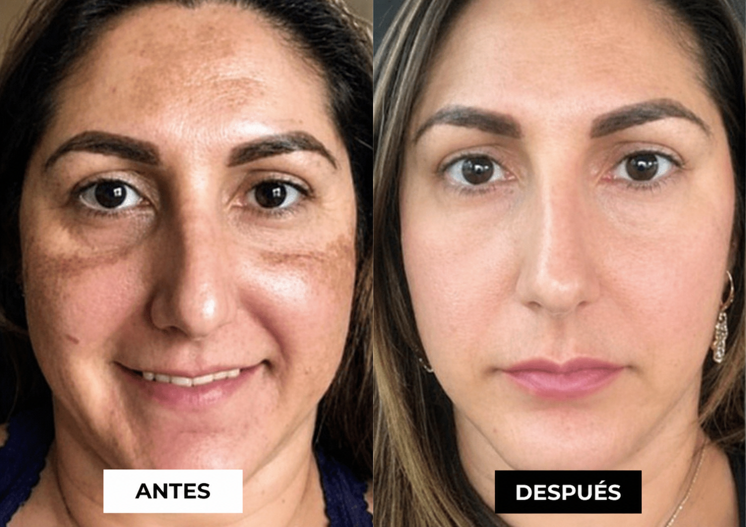 Antes y Después — Ana